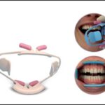 ComfortView® Lip & Cheek Retractor