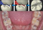 Bausch PROGRESS 100